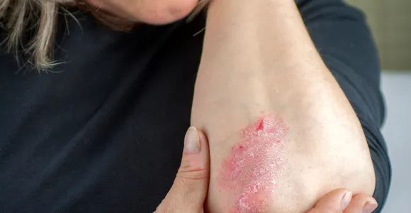 Le psoriasis touche environ 2 % de la population belge.