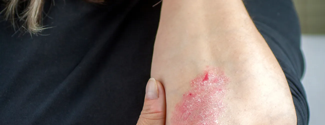Le psoriasis touche environ 2 % de la population belge.